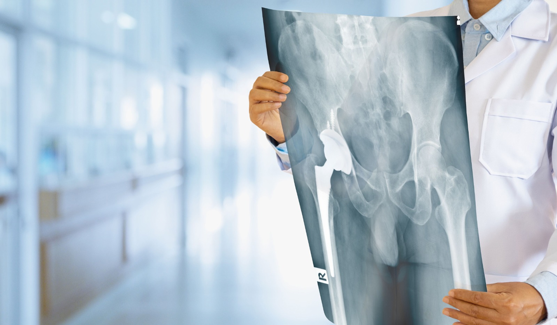 Hip Replacemement Surgery