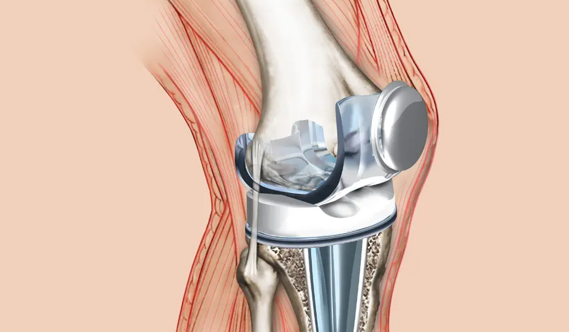 Revision Joint Replacement Surgeries